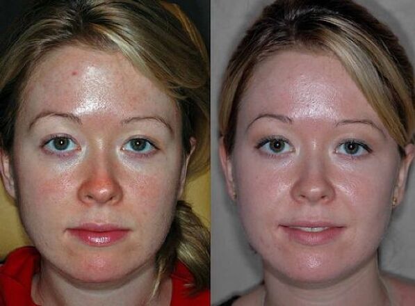 fotografije prije i nakon postupka podmlađivanja plazmom