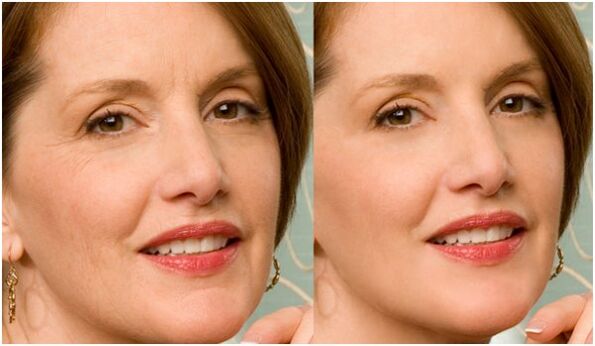 prije i poslije podmlađivanja kože lica plazmom
