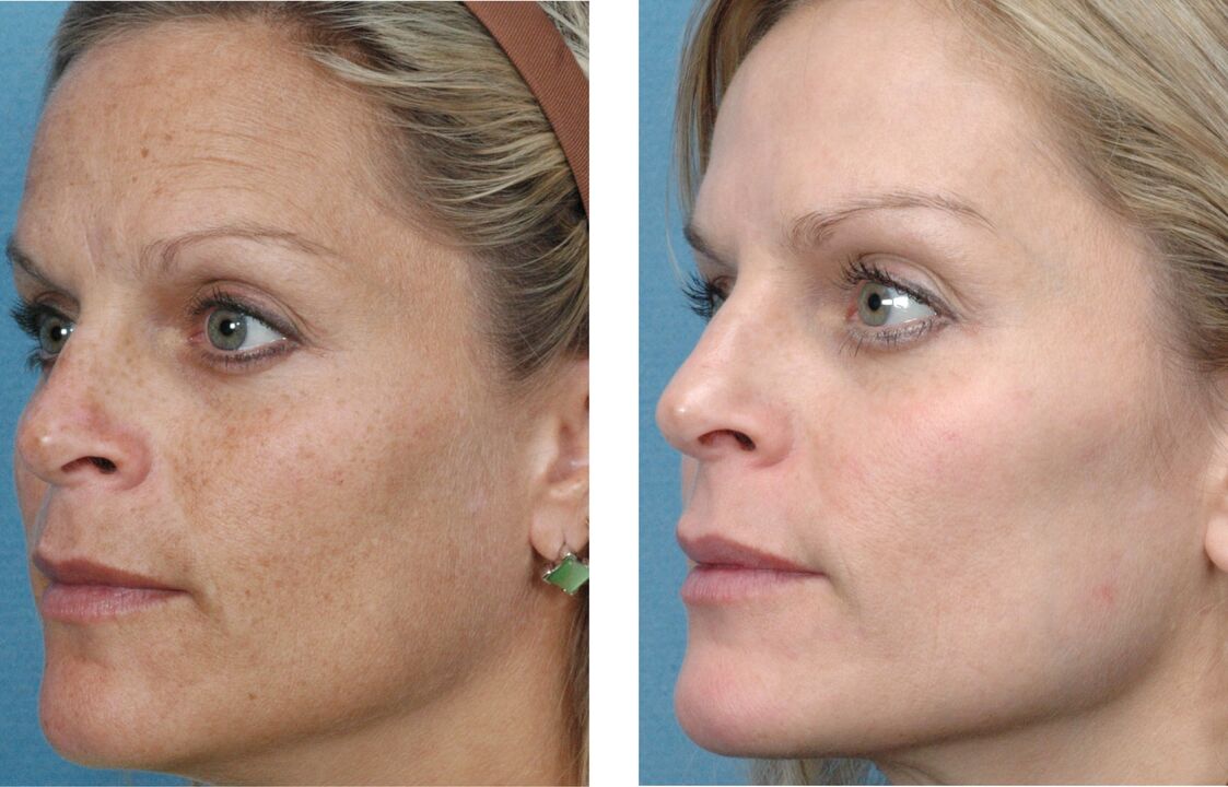 prije i poslije podmlađivanja kože fotografija 1