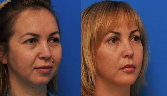 prije i poslije podmlađivanja kože sa zatezanjem fotografija 1