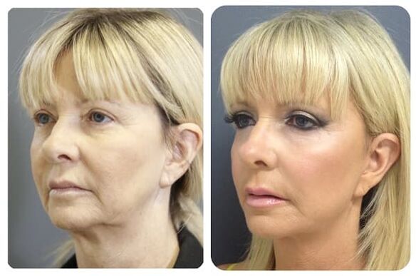 prije i poslije podmlađivanja kože sa zatezanjem fotografija 2