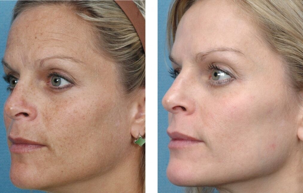 prije i poslije podmlađivanja kože