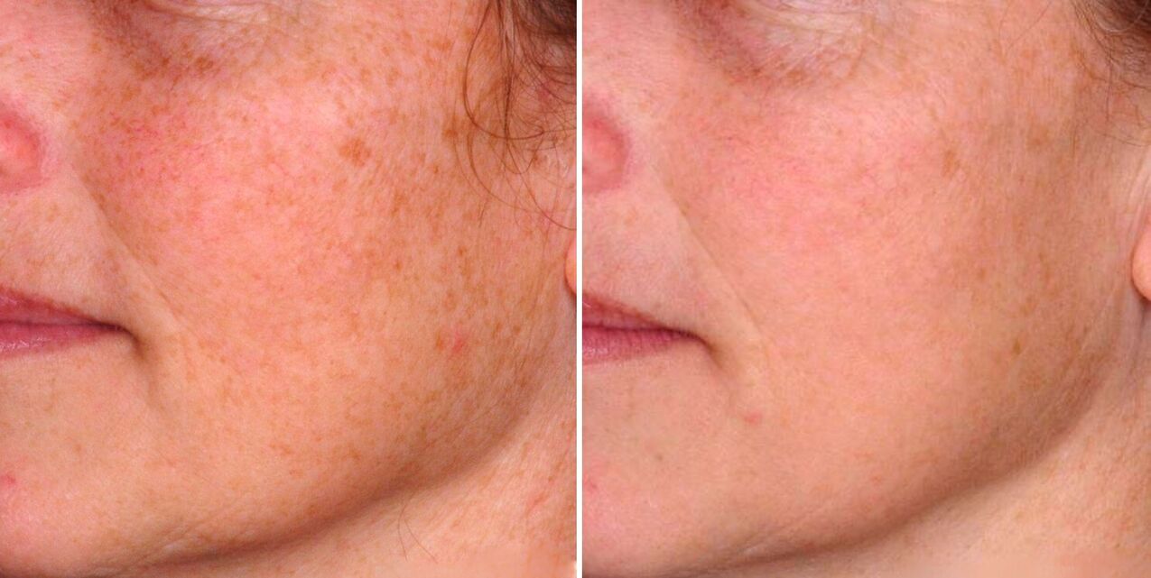 Rezultat frakcijske fototermolize je smanjenje staračkih pjega na koži lica. 