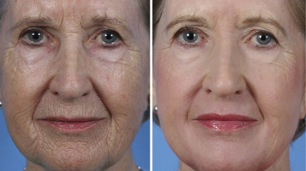 frakcijsko podmlađivanje lica prije i poslije fotografija
