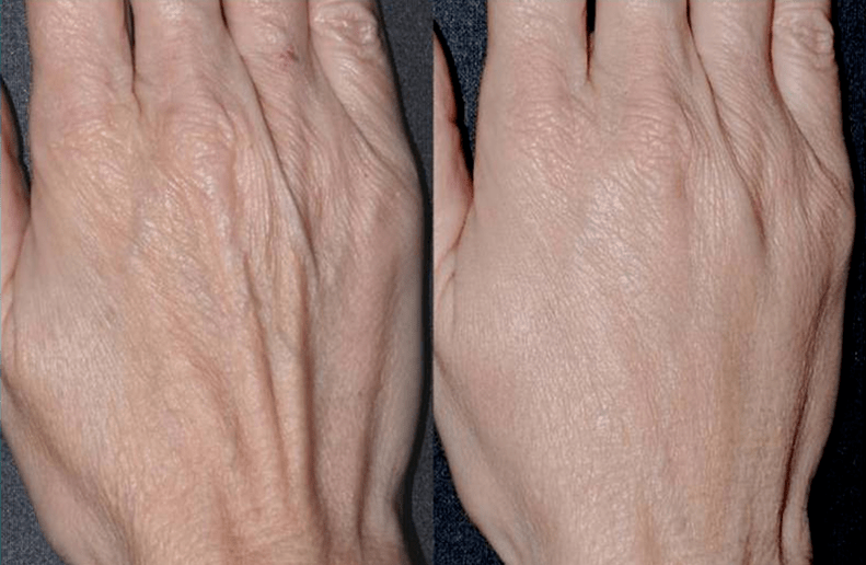 konturna plastika, podmlađivanje ruku fotografija 2 prije i poslije