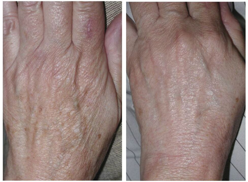 lasersko podmlađivanje ruku prije i poslije fotografija